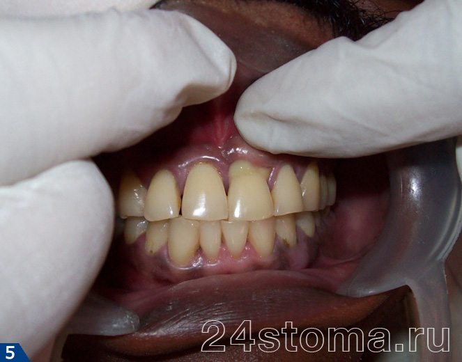 Внешний вид зуба, представленного на рентгенограмме рис 4.