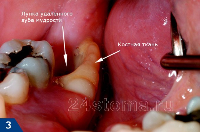 Обнажение костной ткани альвеолы после удаления зуба мудрости