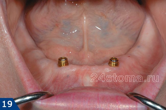 Вид беззубой нижней челюсти с вживленными в нее двумя имплантами
