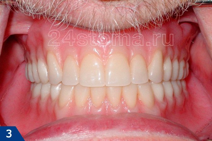 Вид полных съемных зубных протезов на вернюю и нижнюю челюсти в полости рта