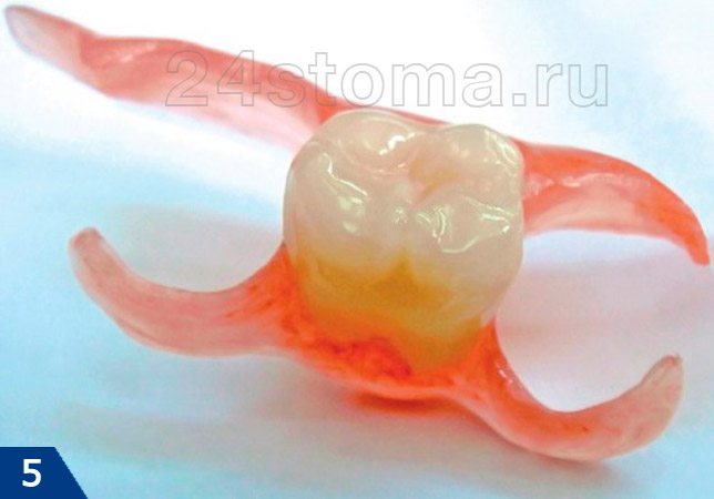 Акриловый протез на один зуб (протез-бабочка)