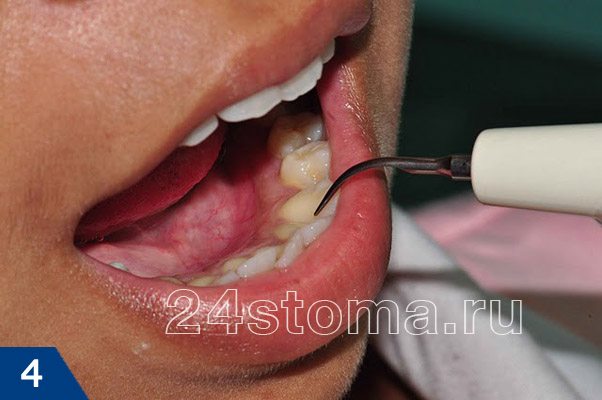 Ультразвуковой наконечник во рту у пациента