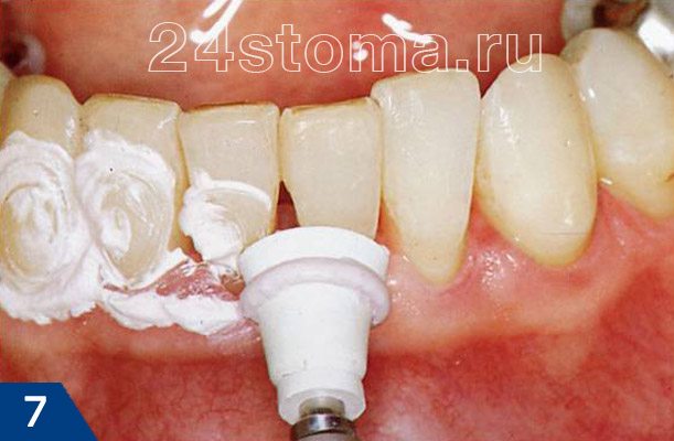 Полировка зубов после снятия зубных отложений