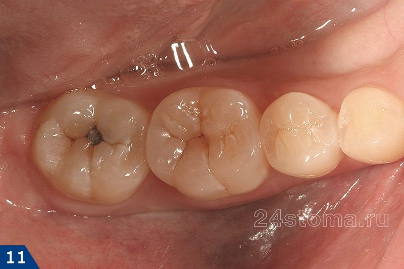 Исходное состояние 6 и 7 зубов перед инвазивной герметизацией фиссур (на 7м зубе имеется небольшая амальгамовая пломба)