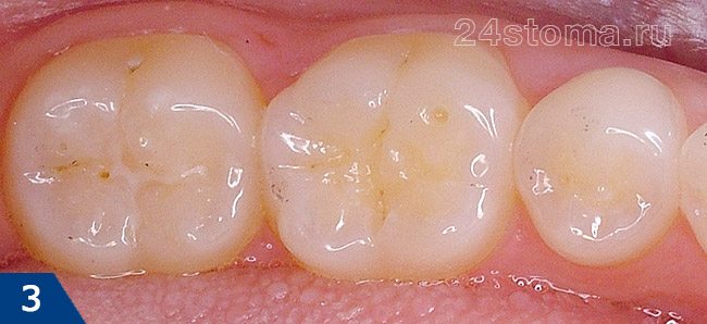 Вид жевательных зубов до неинвазивной герметизации фиссур