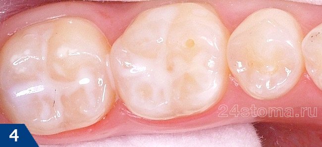 Вид жевательных зубов после неинвазивной герметизации фиссур