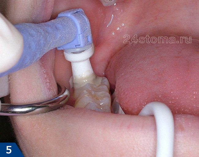 В качестве подготовки к герметизации зубы полируются специальными щетками и пастами