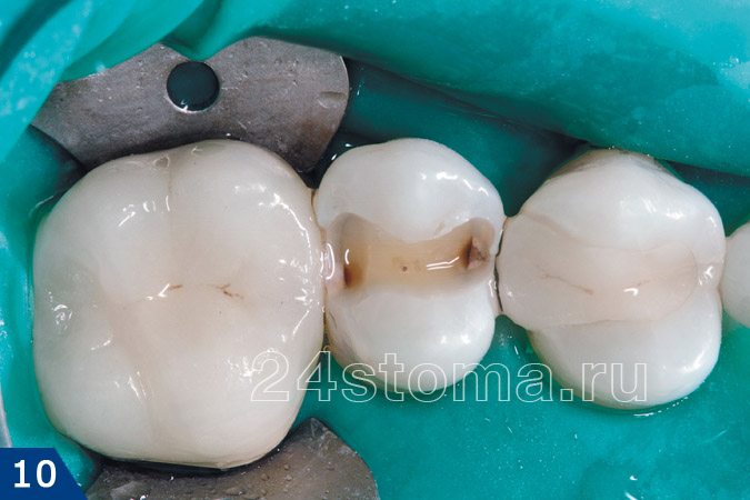 Снята пломба с 5-го малого коренного зуба - видно два очага межзубного кариеса