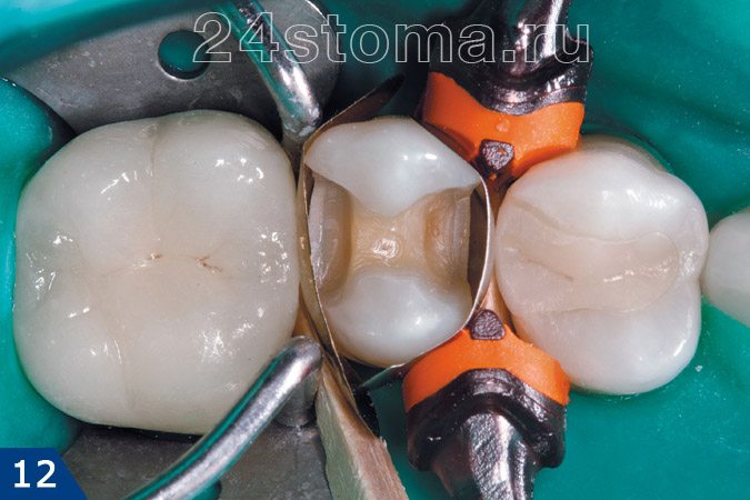 Для того, что бы восстановить боковые стенки зуба наложены металлическая матрица и клинья