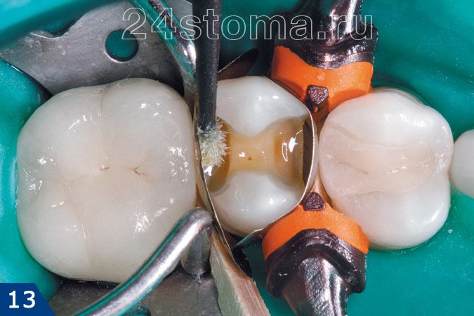 Поверхность дефекта обрабатывается адгезивом (для улучшения прилипаемости пломбы к тканям зуба)