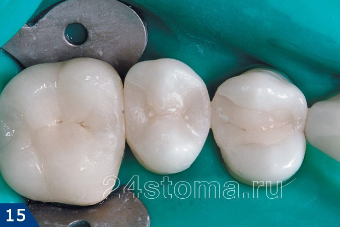 Коронка зуба полностью восстановлена, включая бугры и фиссуры
