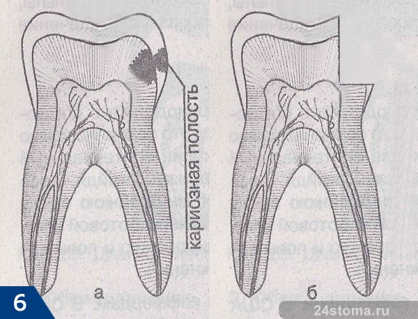 Препарирование зуба при лечении межзубного кариеса