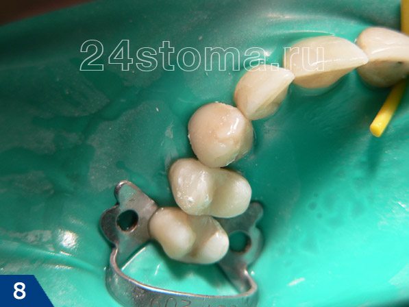 Зуб после восстановления боковой стенки и жевательной поверхности (окончательная полировка еще не произведена)