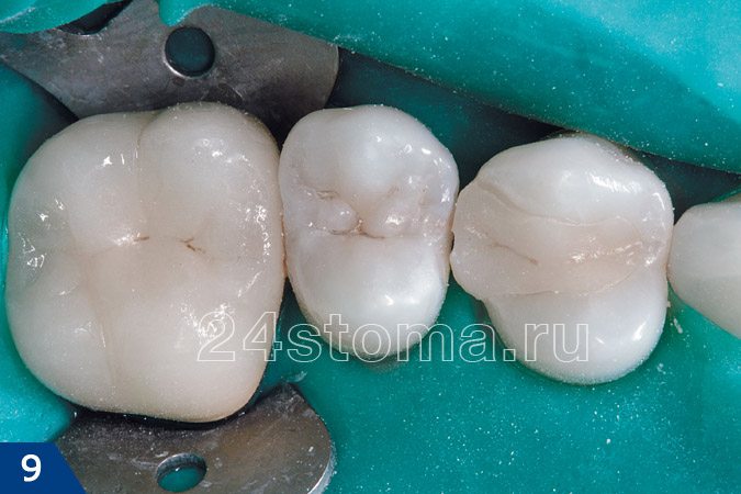 Исходная ситуация: 4й и 5й малые коренные зубы под пломбами. На рентгене 5го зуба обнаружен межзубной кариес.