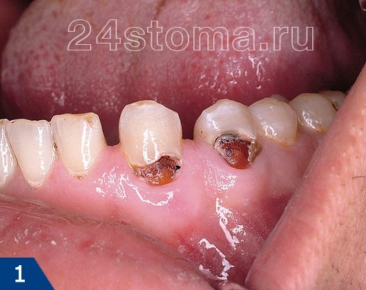 Пришеечный кариес зубов нижней челюсти