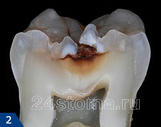 Вид кариеса на распиле зуба