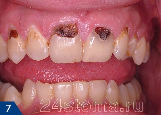 Пришеечный кариес в области верхних зубов