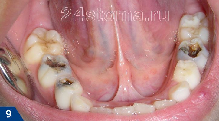 Кариес на жевательных поверхностях нижних зубов