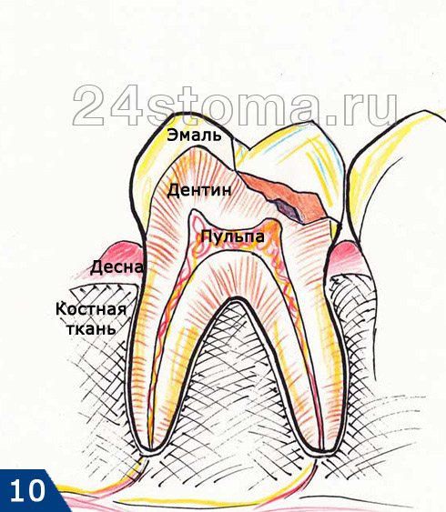 Восстановление коронки зуба (постоянная пломба)