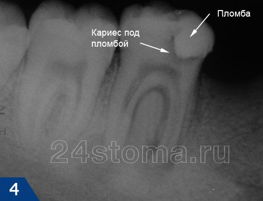 Рентгенограмма нижнего зуба: вид глубокого кариеса под пломбой
