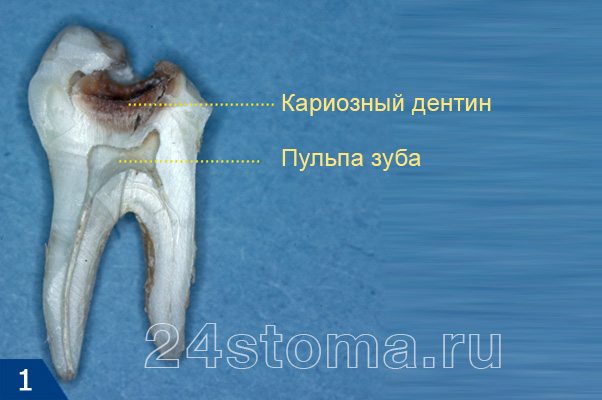 Вид глубокого кариеса на распиле зуба
