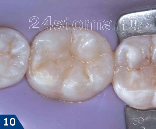 Полость полностью закрыта пломбировочным материалом, сформированы бугры и фиссуры зуба