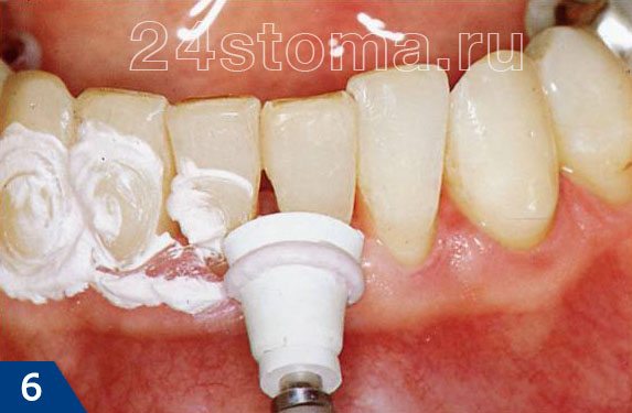 Очистка зубов от налета перед началом лечения поверхностного кариеса
