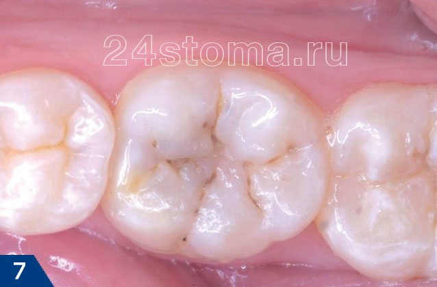 Исходная ситуация: поверхностный кариес в области фиссур жевательного зуба