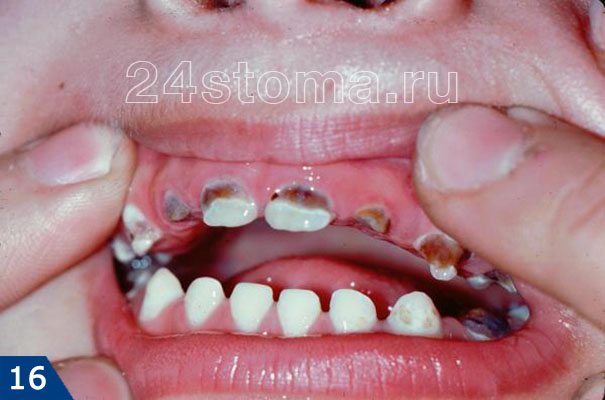 Множественный кариес верхних зубов у ребенка