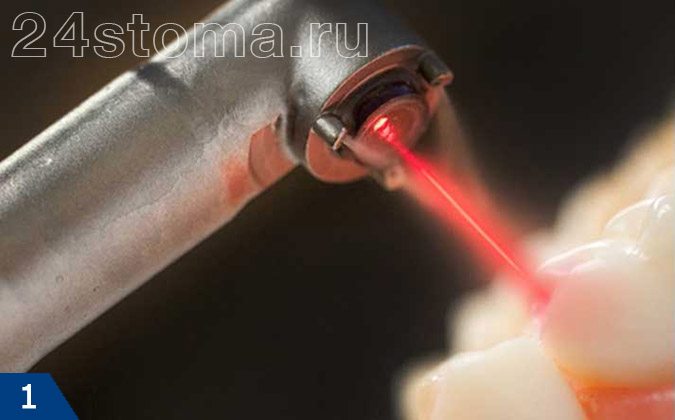 Лазерный наконечник для препарирования твердых тканей зуба