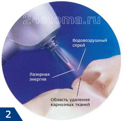 Схема сверления зуба при помощи лазера