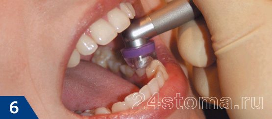 Для герметичности на зуб надевается насадка, соединенная с наконечником аппарата для озоно-терапии