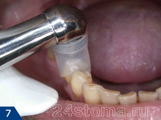 Для герметичности на зуб надевается насадка, соединенная с наконечником аппарата для озоно-терапии