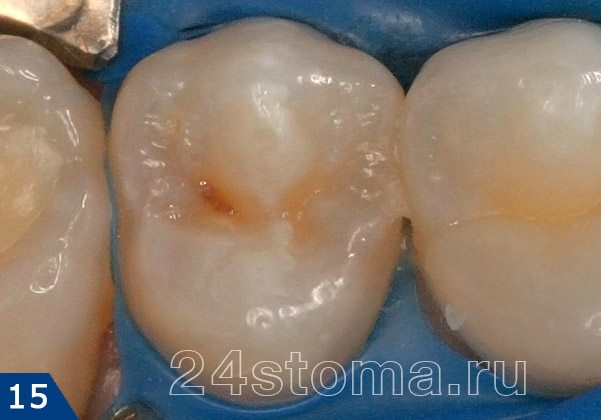 Исходная ситуация: кариес на жевательной поверхности нижнего малого коренного зуба
