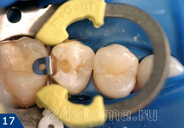 Наложен коффердам (синего цвета) для изоляции зуба от слюны, а также матрицы и клинья для восстановления боковой стенки зуба