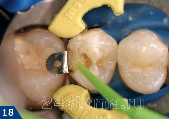 Обработка полости зуба адгезивом