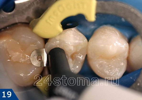 Выдавливание в полость зуба пломбировочного материала