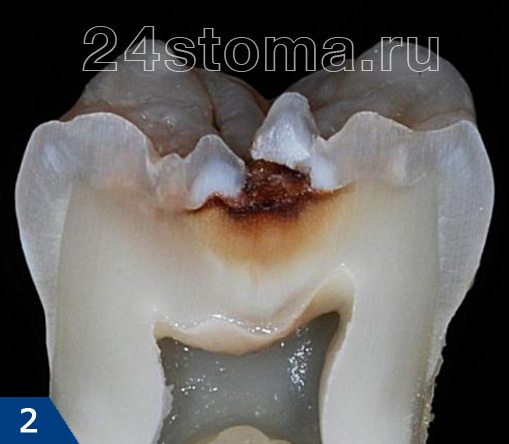Средний кариес (вид на распиле зуба под увеличением)