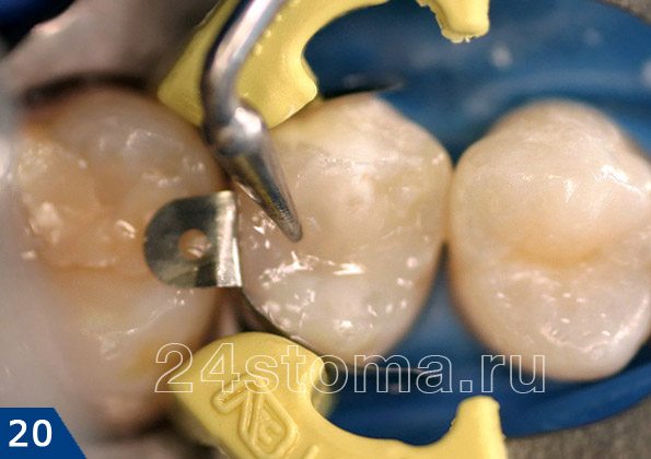 Распределение пломбировочного материала по полости зуба и формирование правильной формы зуба