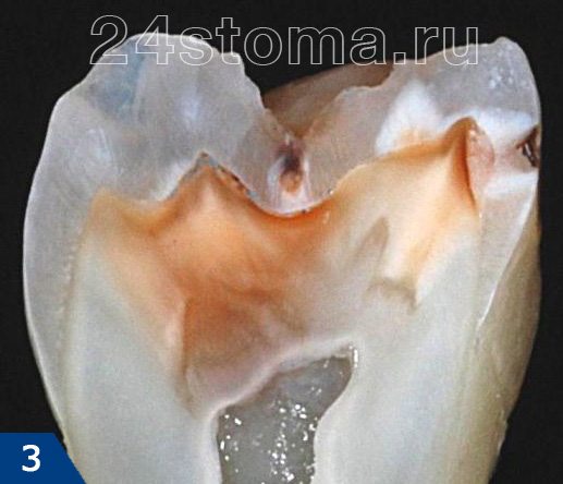 Глубокий кариес (вид на распиле зуба)