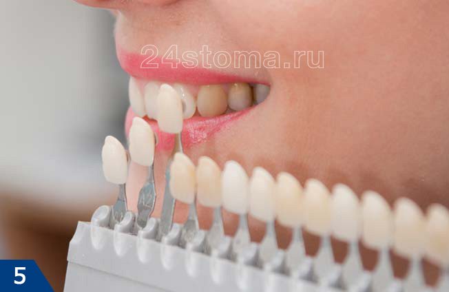 Определение цвета зубов для выбора правильно оттенка пломбировочного материала