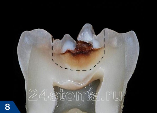 Граница высверливания твердых тканей зуба при лечении кариеса