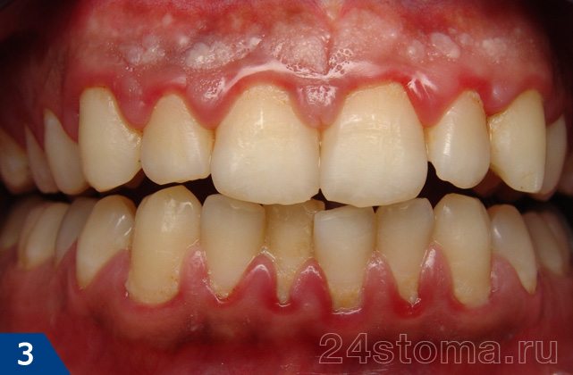 Скопления мягкого микробного зубного налета в области шеек зубов