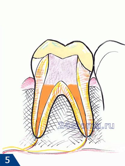 Восстановление коронки зуба пломбировочным материалом