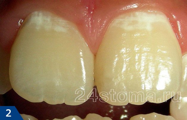 Деминерализация зубной эмали в области шеек зубов (выглядит в виде белых пятен)