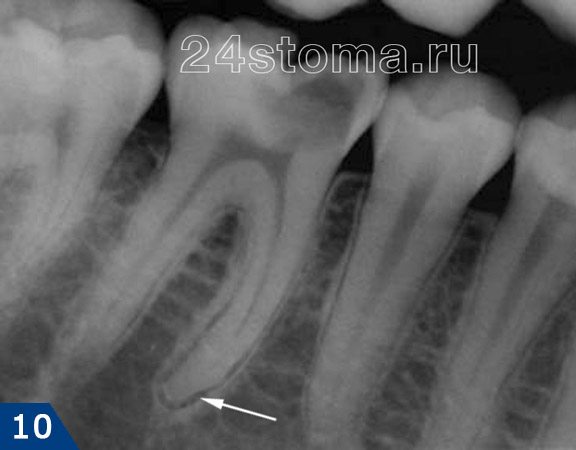 Хронический фиброзный периодонтит (стрелочкой указано расширение периодонтальной щели зуба)