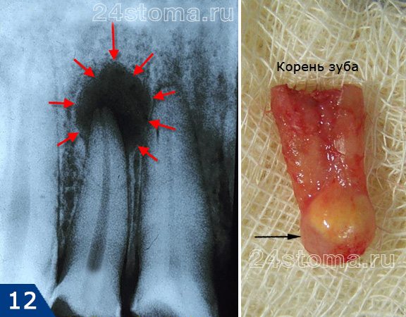 Хр.гранулематозный периодонтит (киста) на рентгеновском снимке и на верхушке корня удаленного зуба