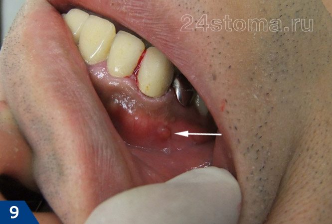 Хронический периодонтит зуба под коронкрй (свищевое отверстие указано стрелочкой)