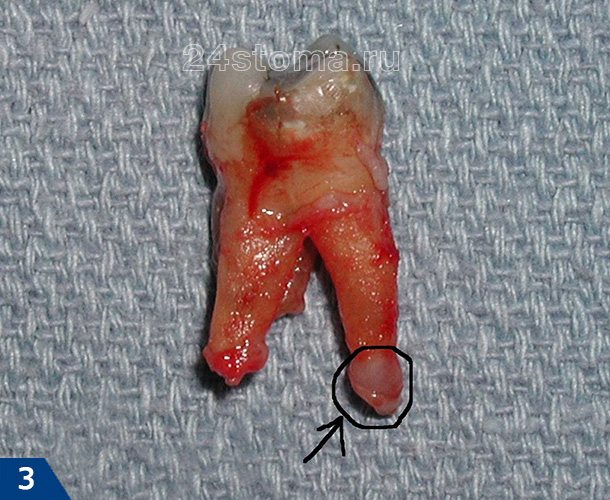 Периапикальный абсцесс в виде гранулемы на верхушке корня удаленного зуба (при хроническом периодонтите)