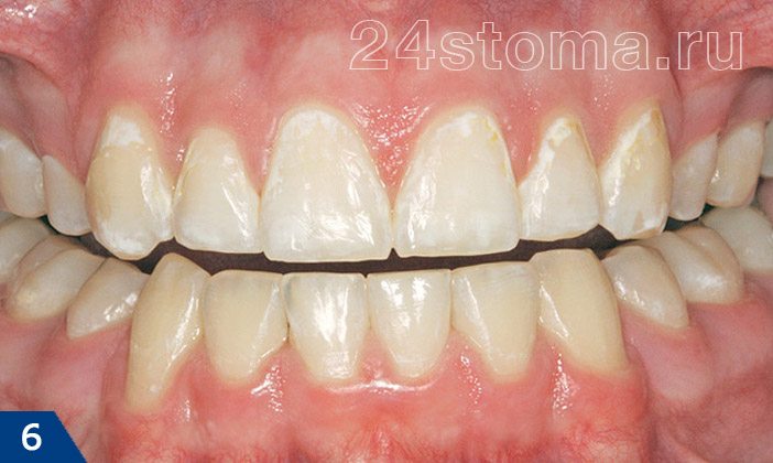 Кариес в стадии белого пятна на шейках верхних зубов